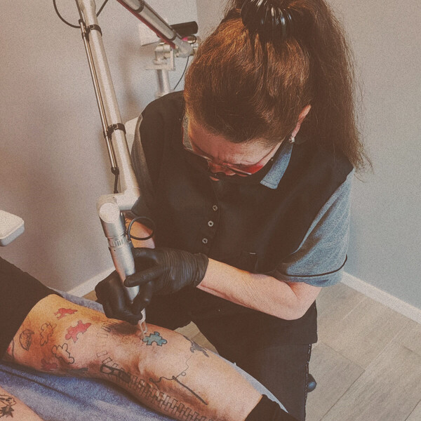 Tattoo verwijderen door middel van laser